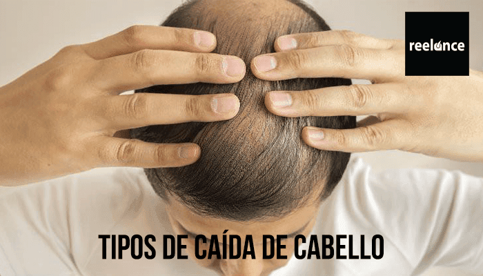 Tipos de caída de cabello