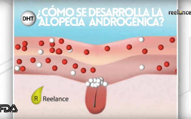 como se desarrolla alopecia androgenica