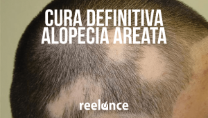 cura definitca alopecia areata
