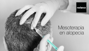 mesoterapia alopecia