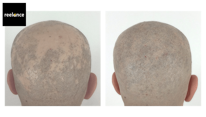 solucion alopecia areata